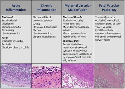 Leveraging the placenta to advance neonatal care